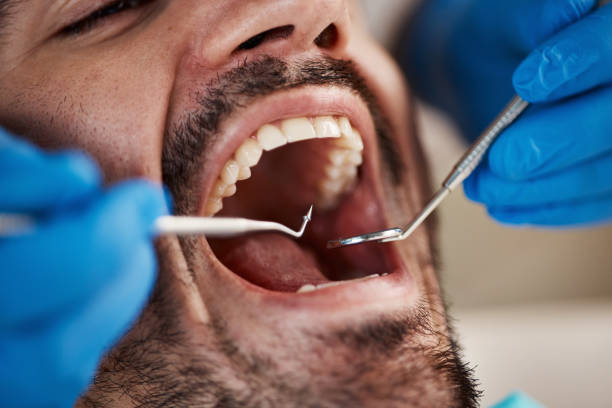 Best Emergency Gum Treatment in Hanover, MN